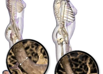 Dr Mário Sérgio é Médico fala sobre a osteoporose