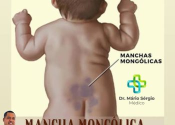 DR. Mário sérgio fala sobre as manchas mongólicas