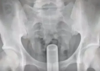 Homem vai coçar as costas com cabo de vassoura e sem querer introduz objeto no ânus em São Mateus