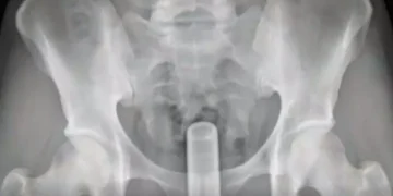 Homem vai coçar as costas com cabo de vassoura e sem querer introduz objeto no ânus em São Mateus Homem vai coçar as costas com cabo de vassoura e sem querer introduz objeto no ânus em São Mateus